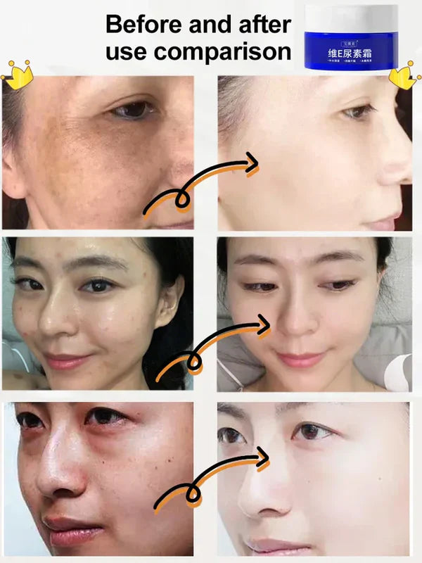 Korean Vitamin E Urea Cream 100g (BUY 1 GET 1 FREE)